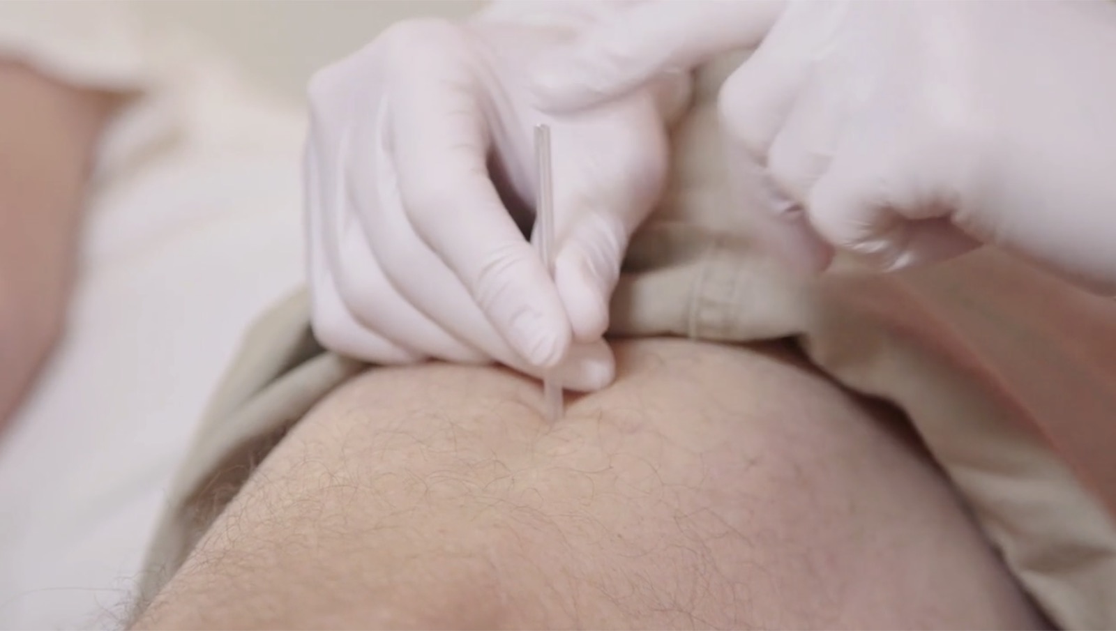 IMS dry needling treatment performed by a physiotherapist at Envision Physiotherapy Vancouver